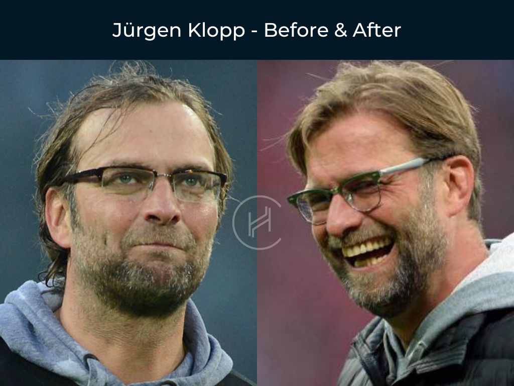 Jürgen Klopp - Hair Transplant Before & After