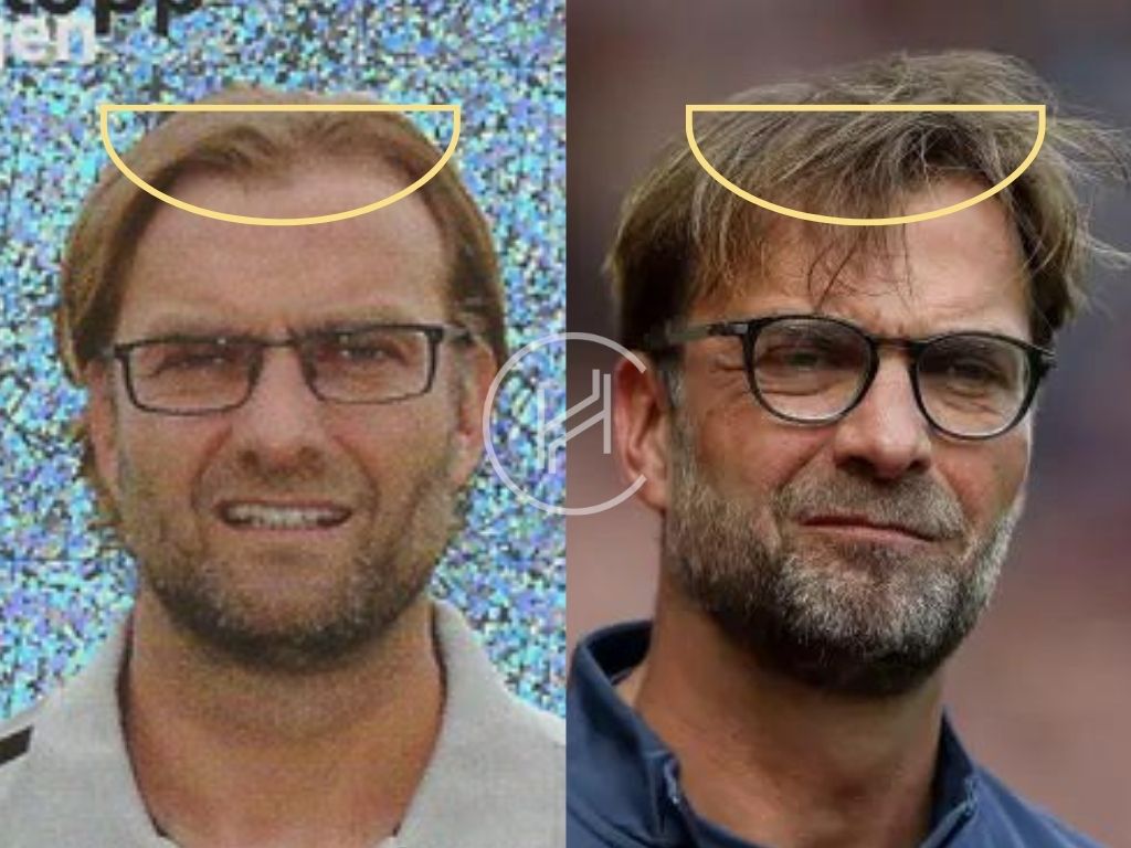 Jurgen Klopp Hair Transplant Before and After Difference