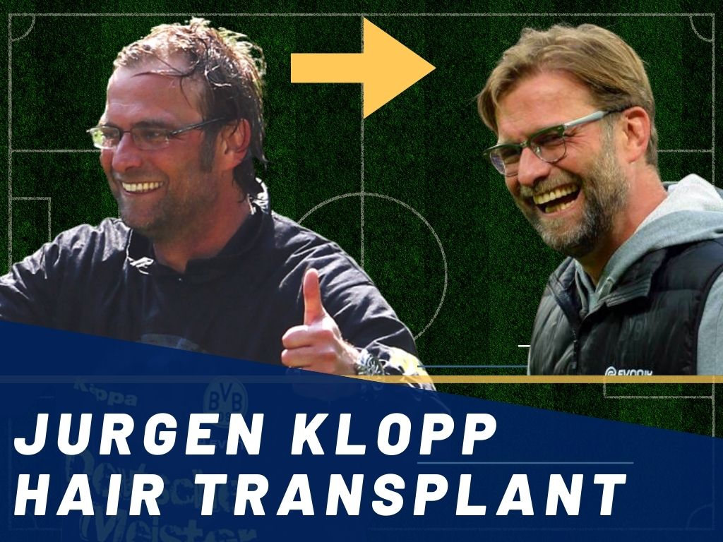 Jurgen Klopp Hair Transplant Analysis Banner