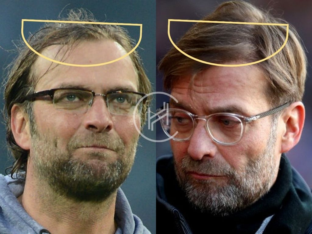 Jurgen Klopp Hairline before and after hair transplant