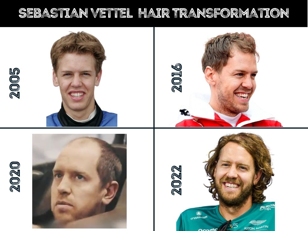 Sebastian Vettel Hair Loss and Hair Transformation