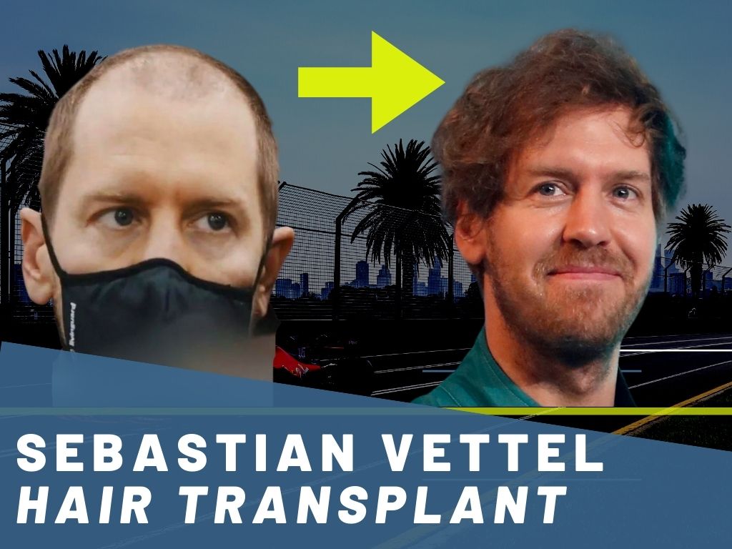 Sebastian Vettel Hair Transplant Analysis Banner