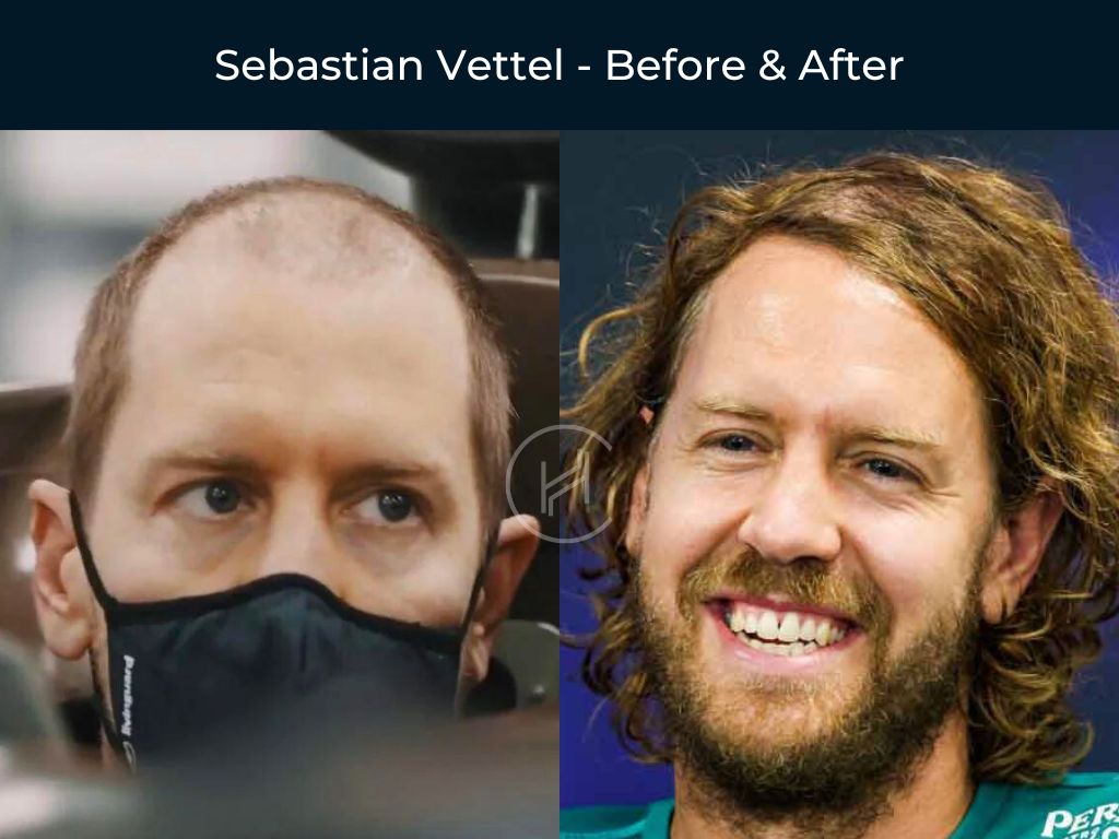 Sebastian Vettel - Hair Transplant Before & After