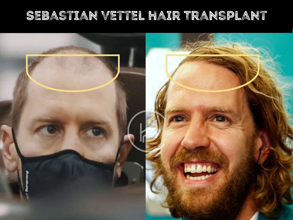 Sebastian Vettel Hair Transplant Before and After