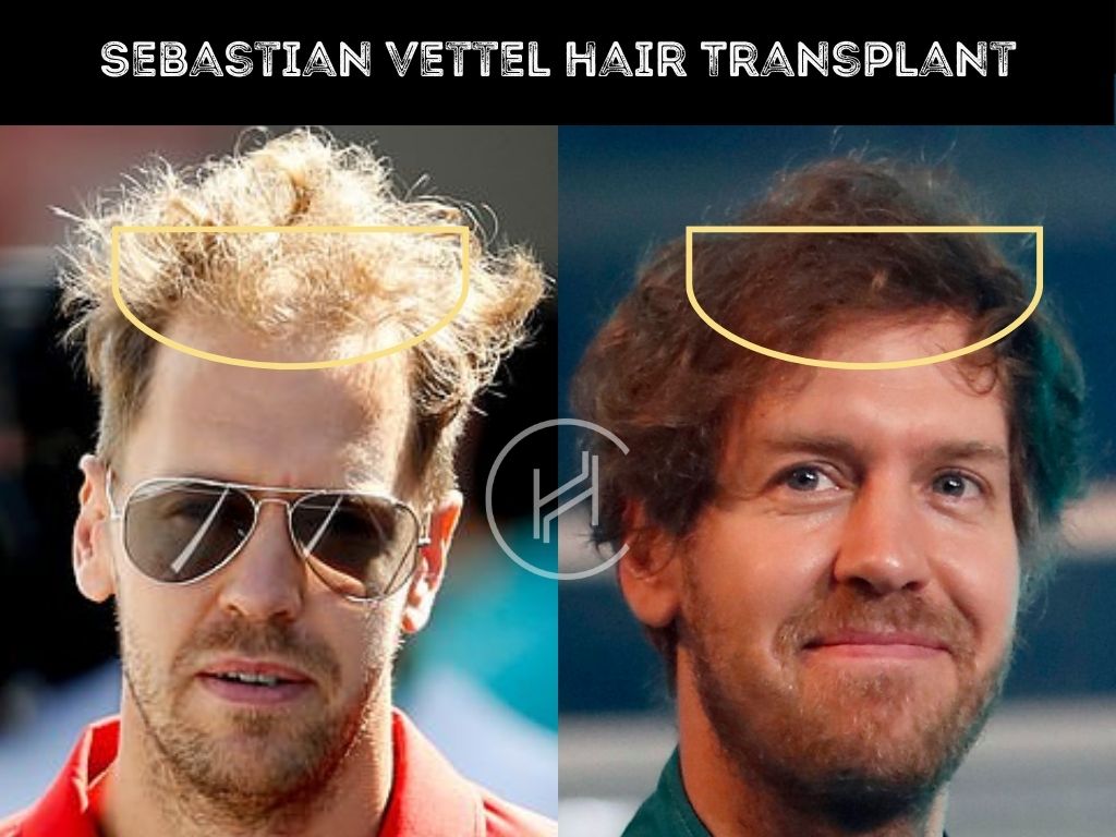 Sebastian Vettel Hair Transplant Result Before After Photo