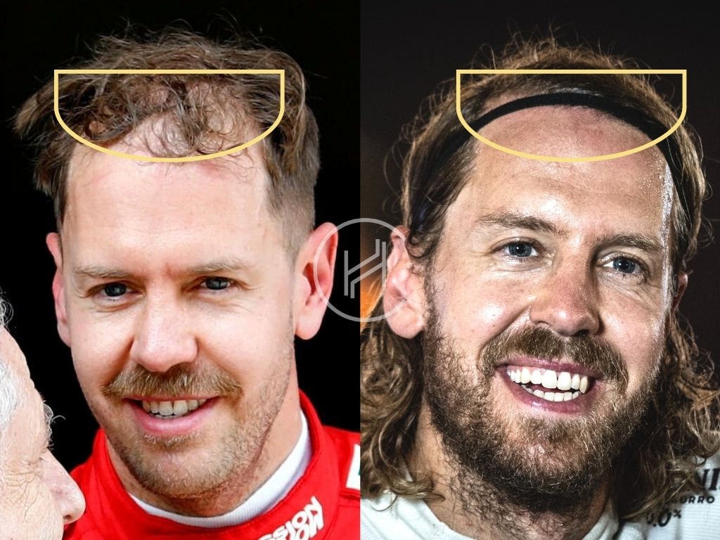 Sebastian Vettel Hair Transplant Result Before and After