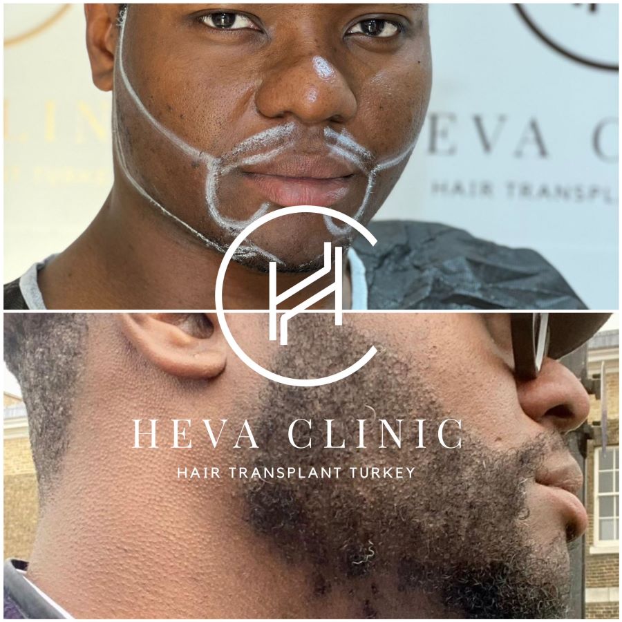afro beard transplant before and after photo 2800 grafts