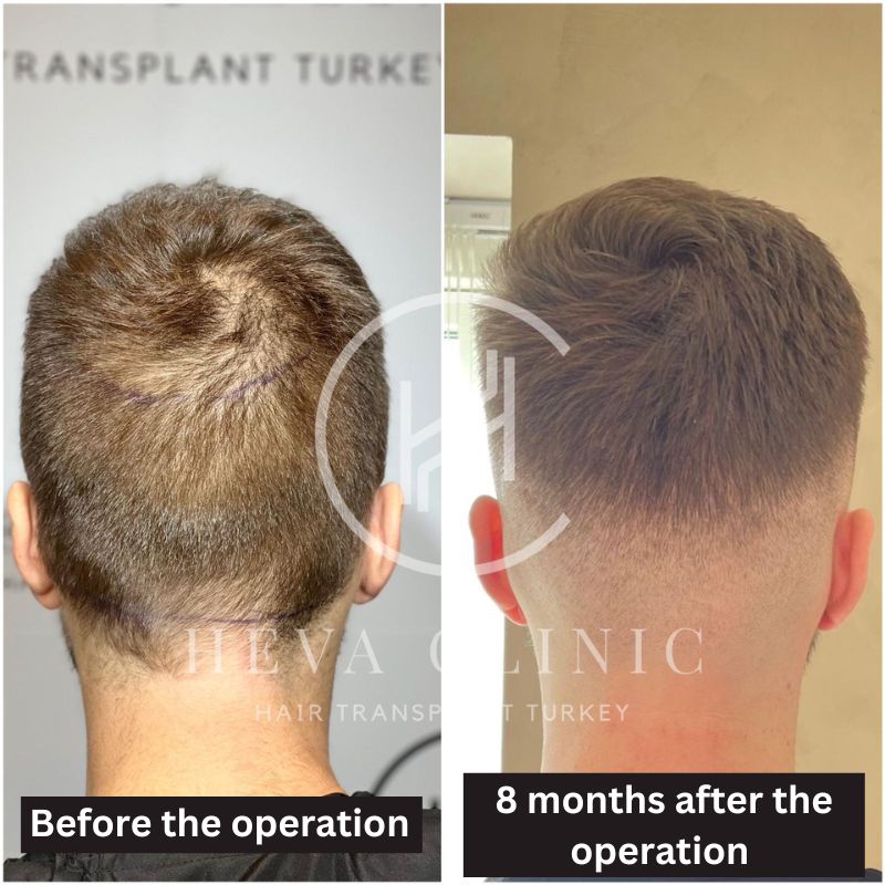 donor area before and 8 months after hair transplant procedure