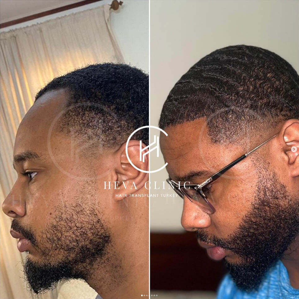 hair and beard transplant afro-textured patient before & after
