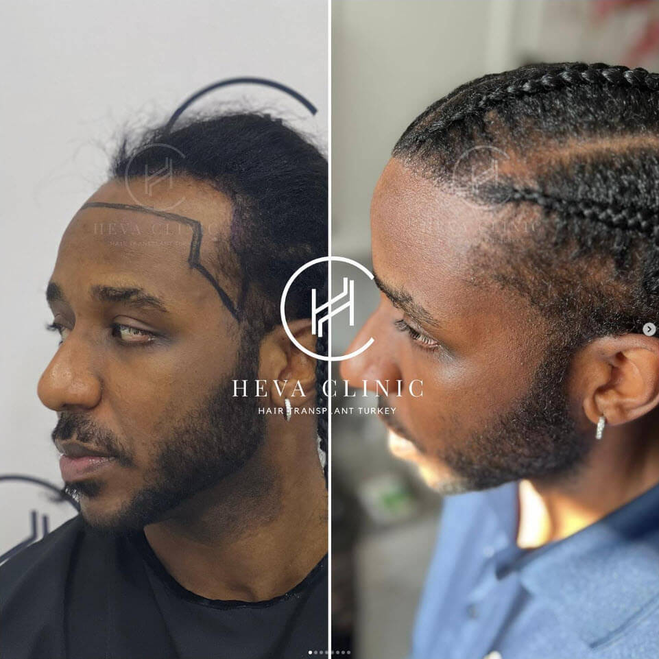 Afro hair transplant results with braids before and after