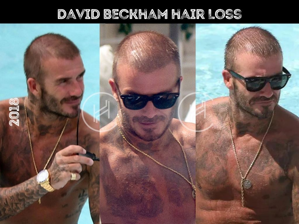 David Beckham Hair Loss