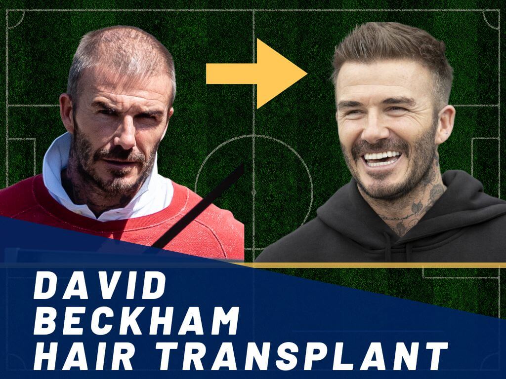 David Beckham Hair Transplant Analysis Photo