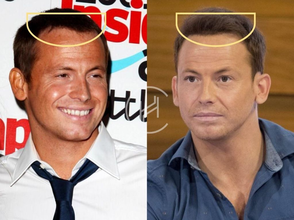 Hair Transplant Before and After Joe Swash Hairline