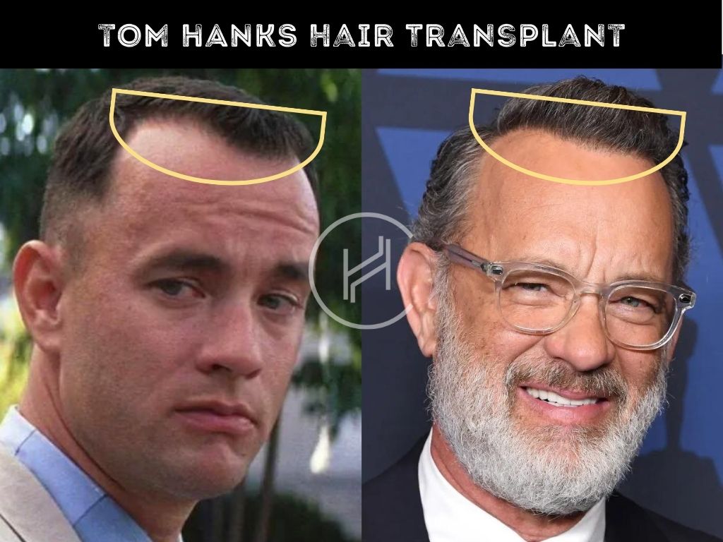 Hair Transplant Tom Hanks Before After Photo