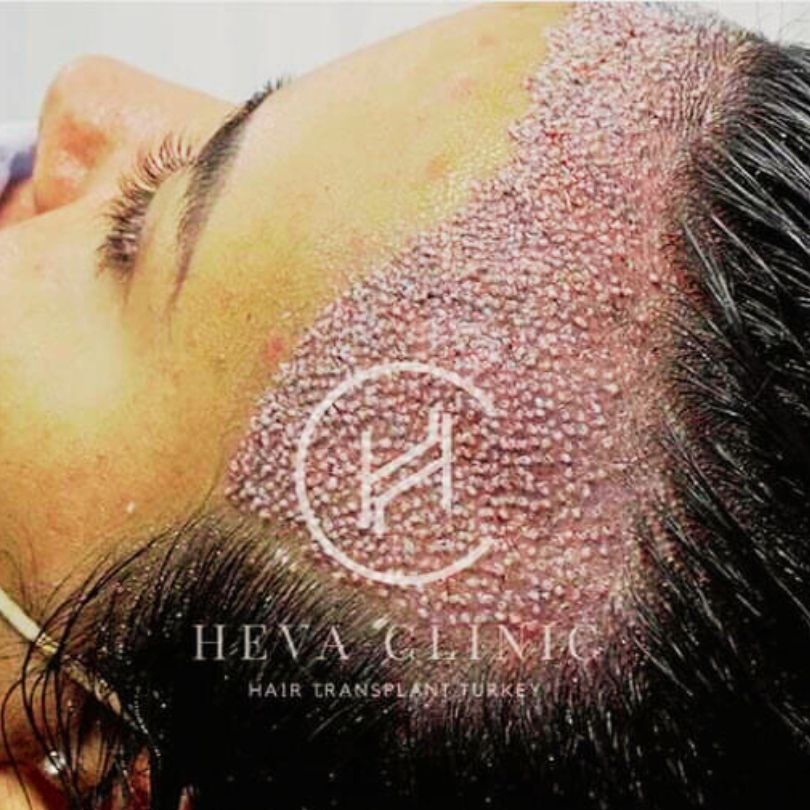 Hair Transplant Trypophobia Example Female After Hair Transplant