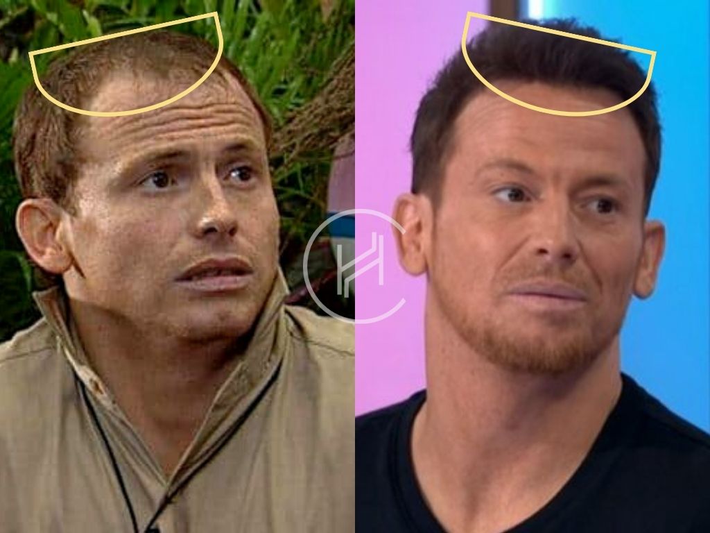 Joe Swash Celebrity Hair Transplant Before and After Photo