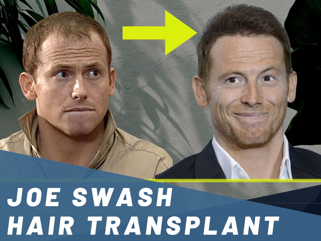 Joe Swash Hair Transplant Analysis Before and After