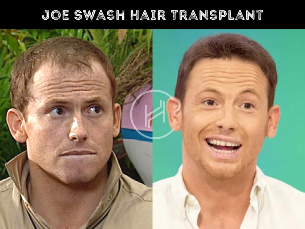 Joe Swash Hair Transplant Before & After Result Comparison