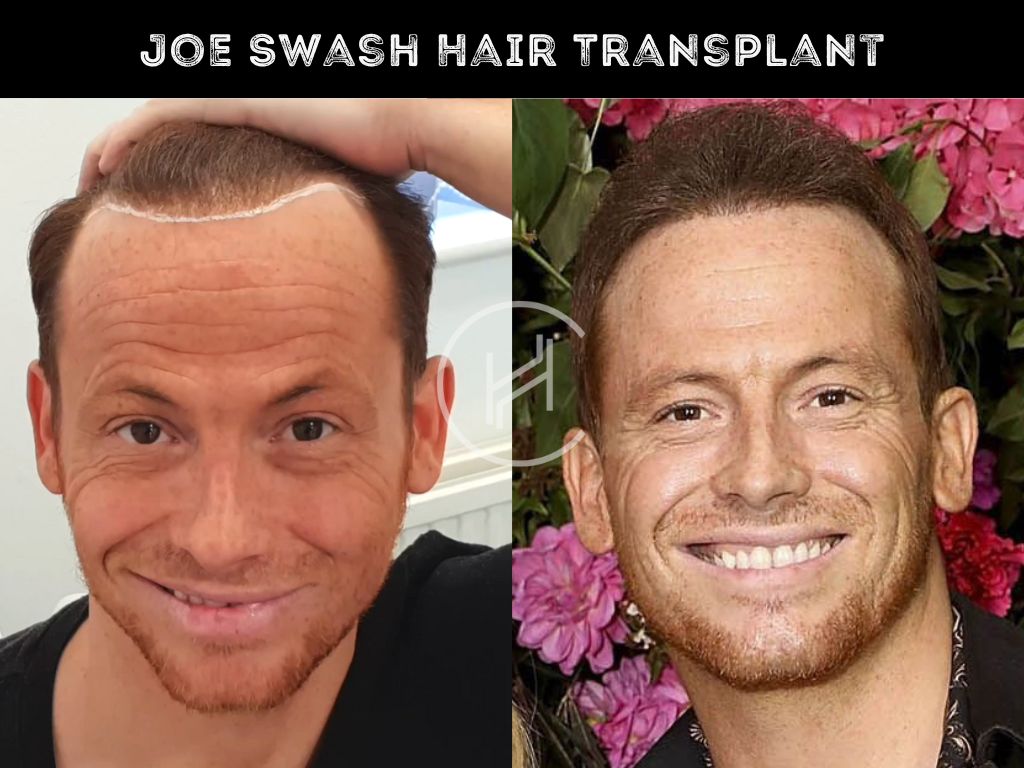 Joe Swash Hair Transplant Before and After Photo