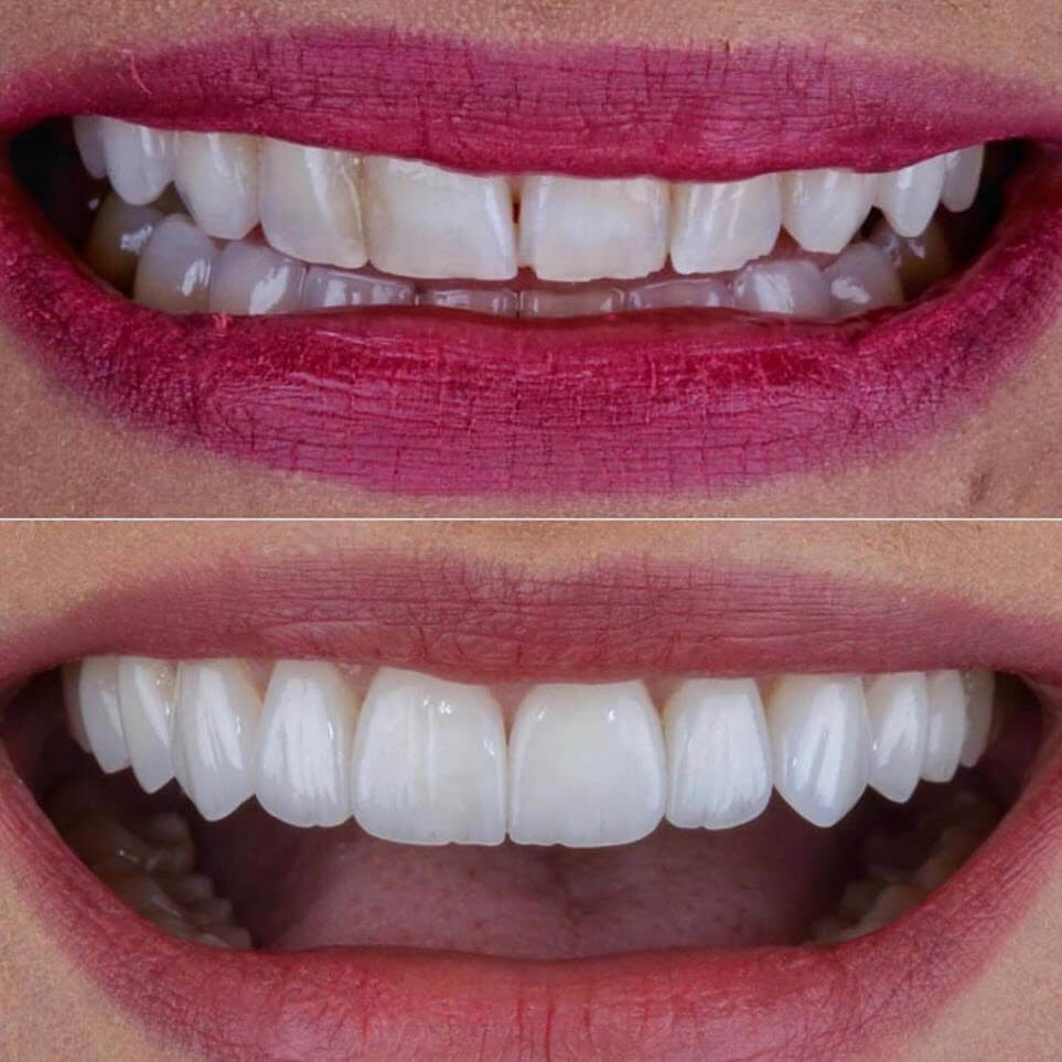 Laminate porcelaine veneers Hollywood Smile