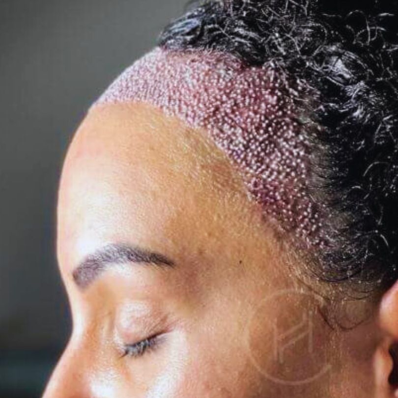 Post Hair Transplant Surgery Holes - Trypophobia Example