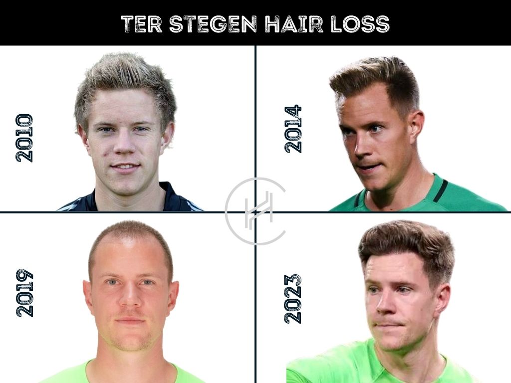 Ter Stegen Hair Loss - Transformation