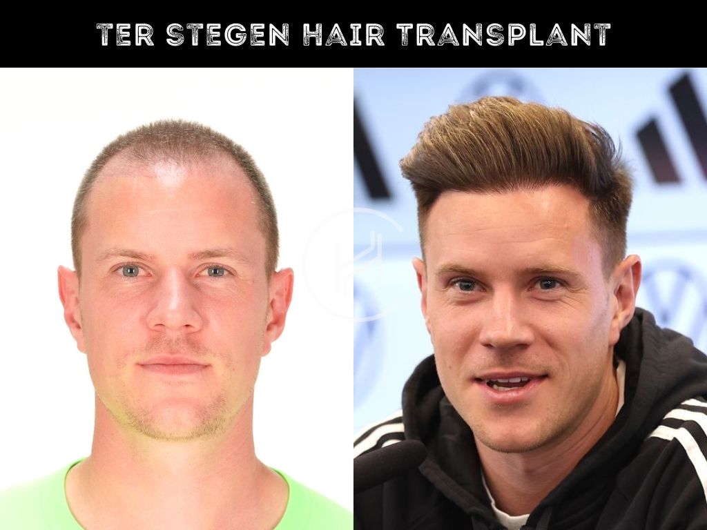 Ter Stegen Hair Transplant Before After Result
