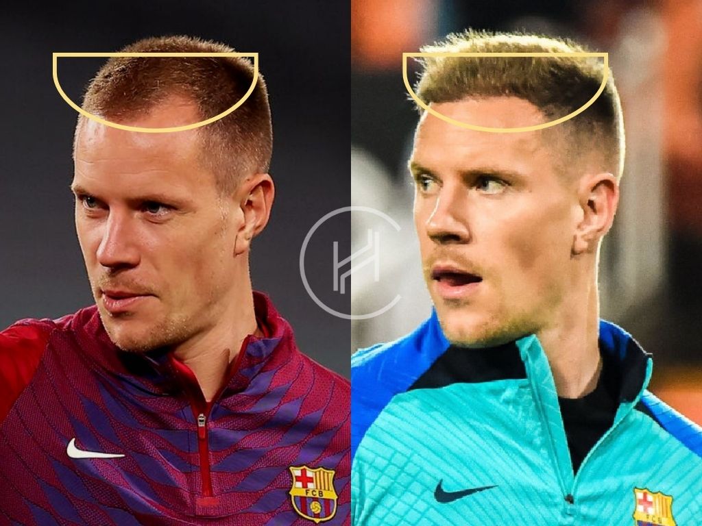 Ter Stegen Hair Transplant Before and After front angle
