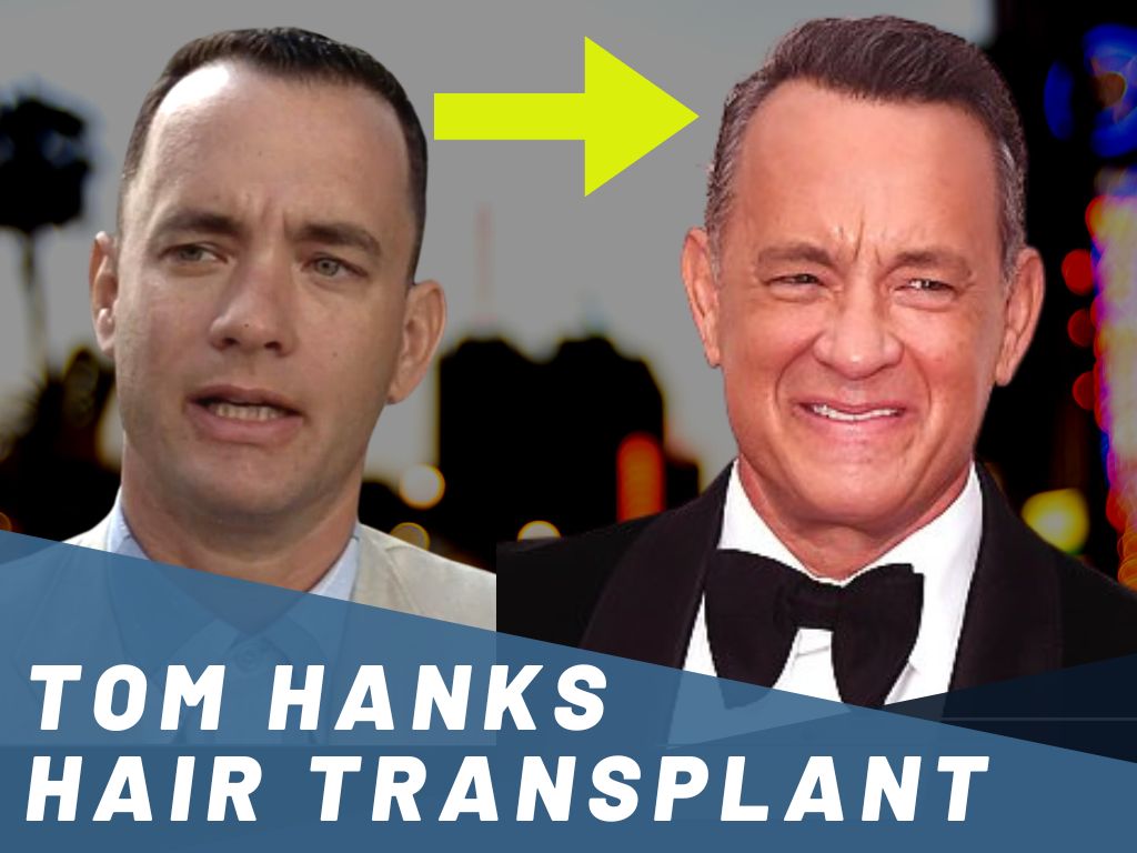 Tom Hanks Hair Transplant Analysis Banner