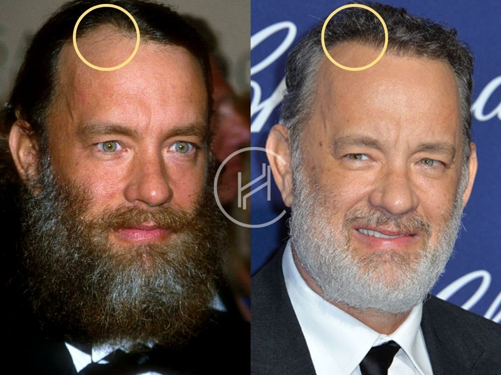 Tom Hanks Hair Transplant Before and After