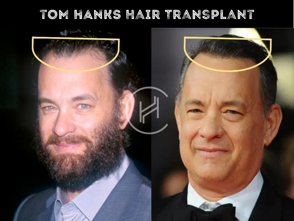 Tom Hanks Hair Transplant Result Before & After Picture