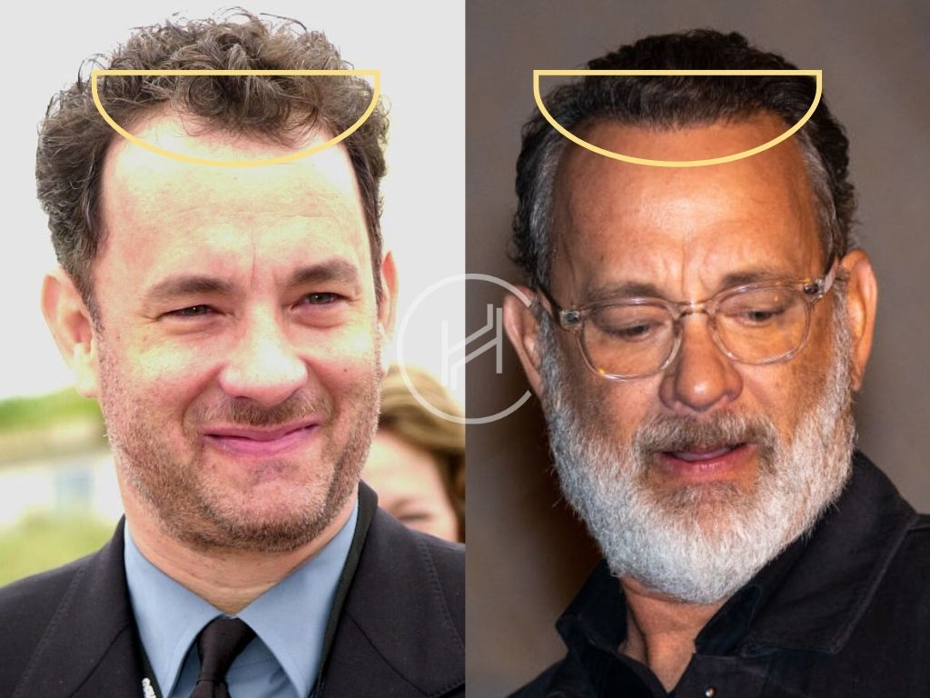 Tom Hanks Hair Transplant Result Hairline Before and After