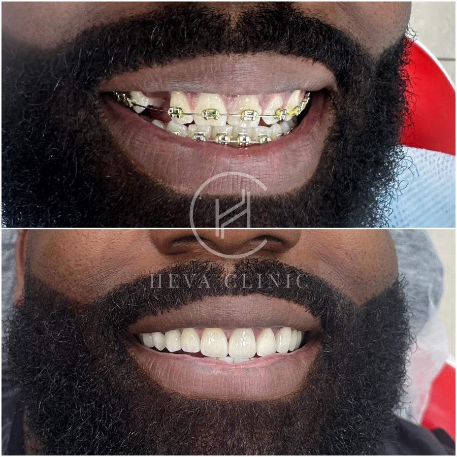 1 session implant with one crown, 9 laminate veneers