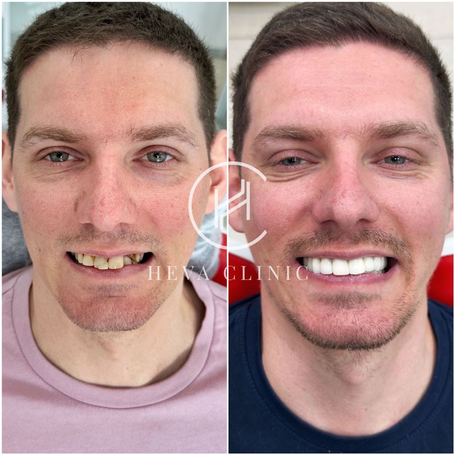 Before and After' Teeth Repair Results