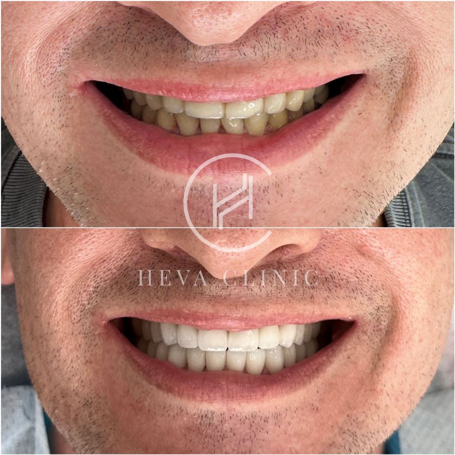 24 zirconium crowns before and after