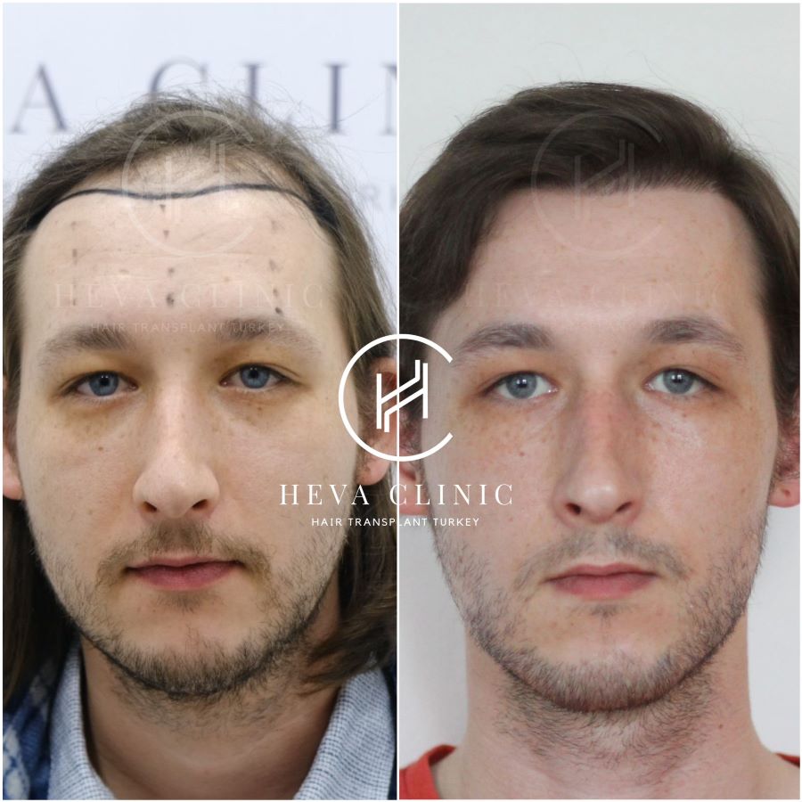 3200 grafts hair transplant result at heva clinic - before and after photo