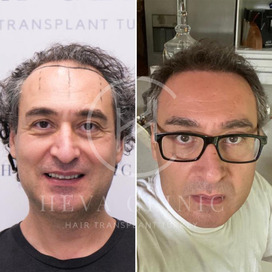 4000 graft grey hair transplant result - before & after