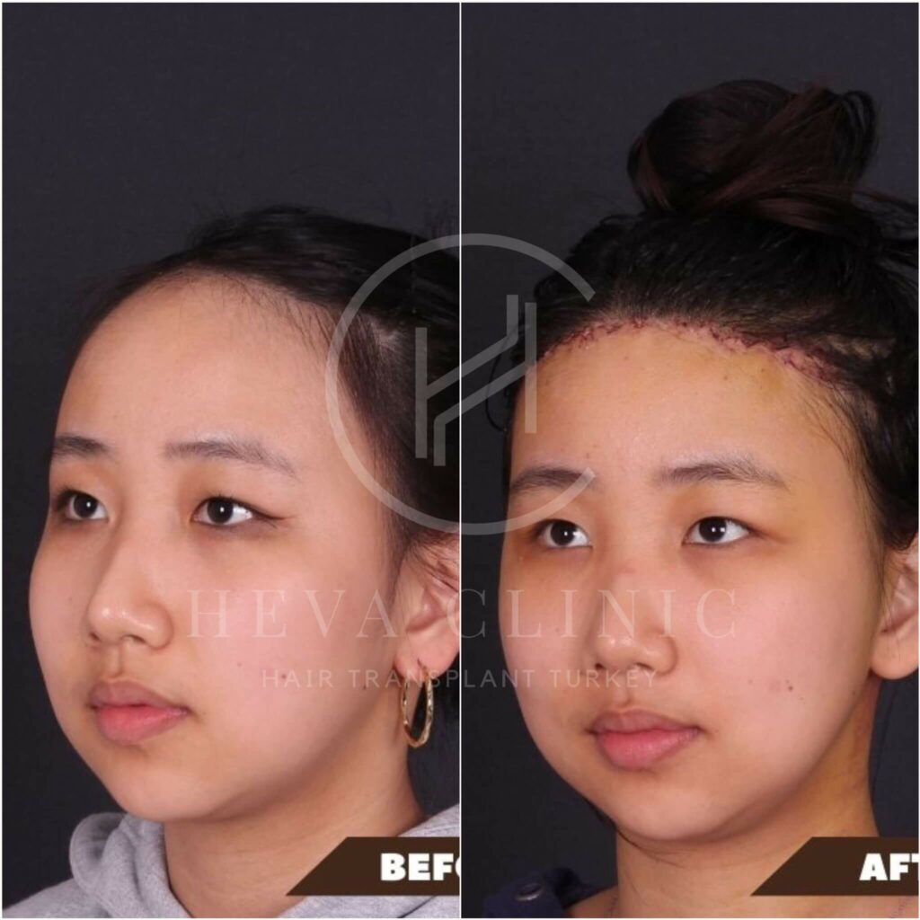 Forehead reduction before and after asian female