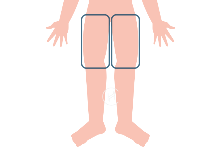 Leg hair for hair transplant