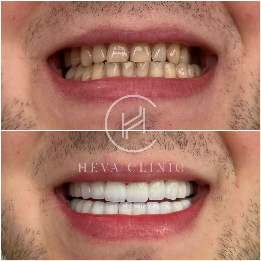 dental treatment 24 zirconium crowns before and after - istanbul