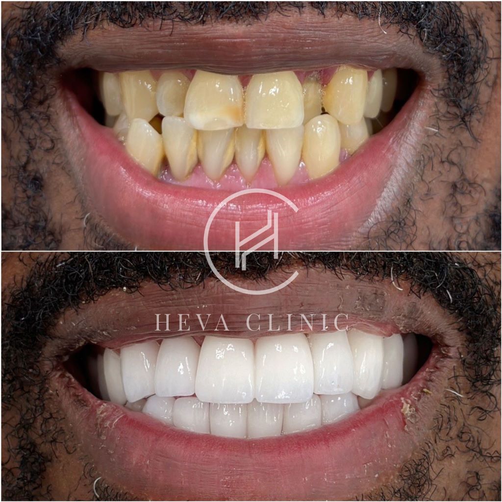 24 zirconium crowns before and after afro patient