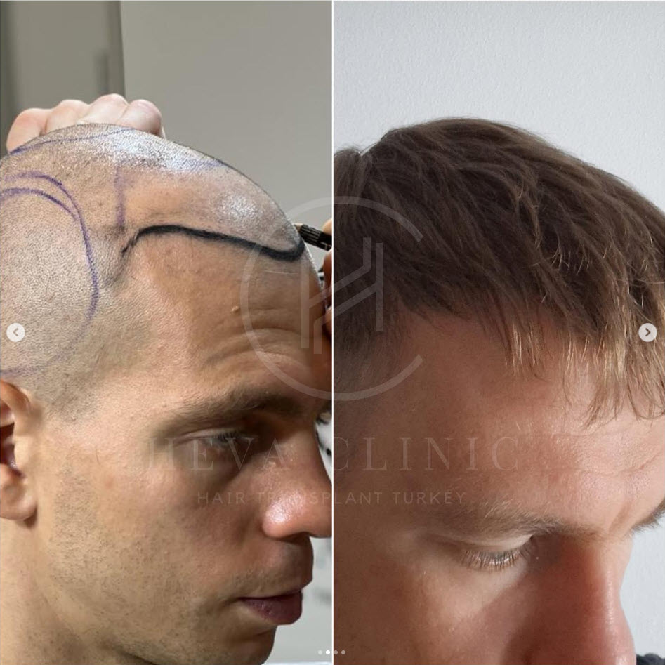 Sapphire Hair Transplant before and after at heva clinic istanbul turkey