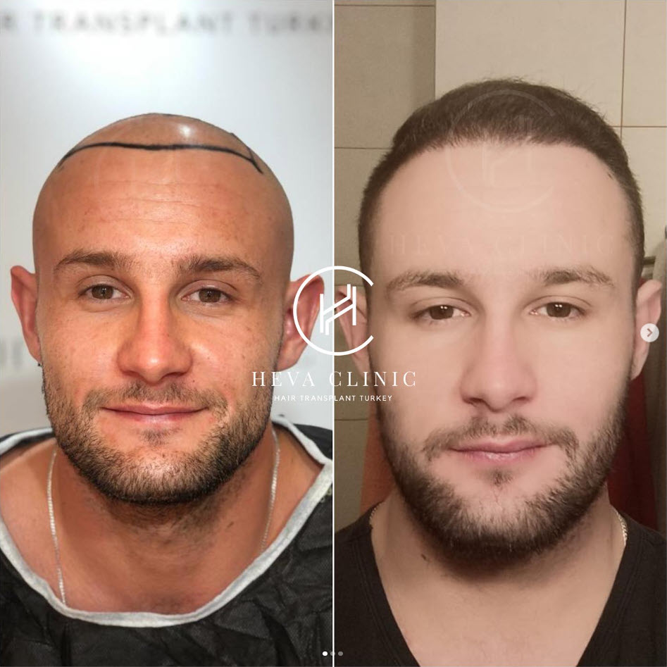 a man after doimg hair transplant