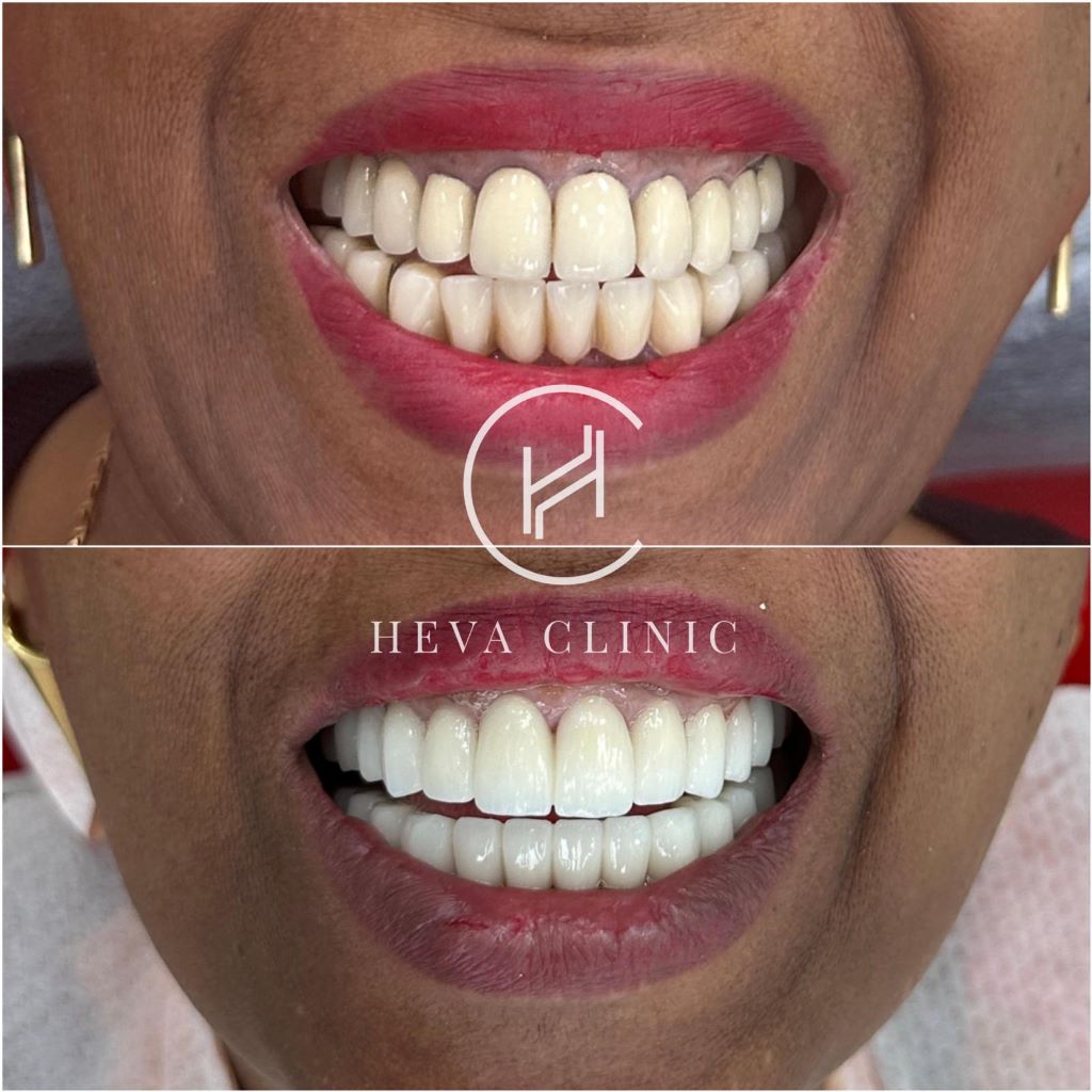 before and after of 24 old crown replacement from porcelain metal fused to zirconium
