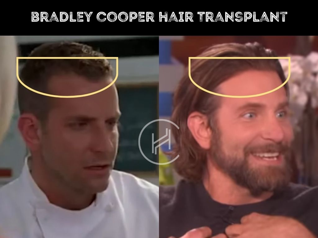 bradley cooper - hair transplant before after result