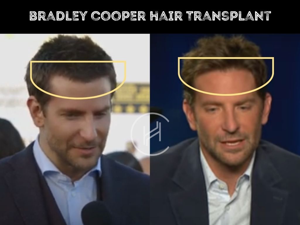 bradley cooper - hair transplant before after