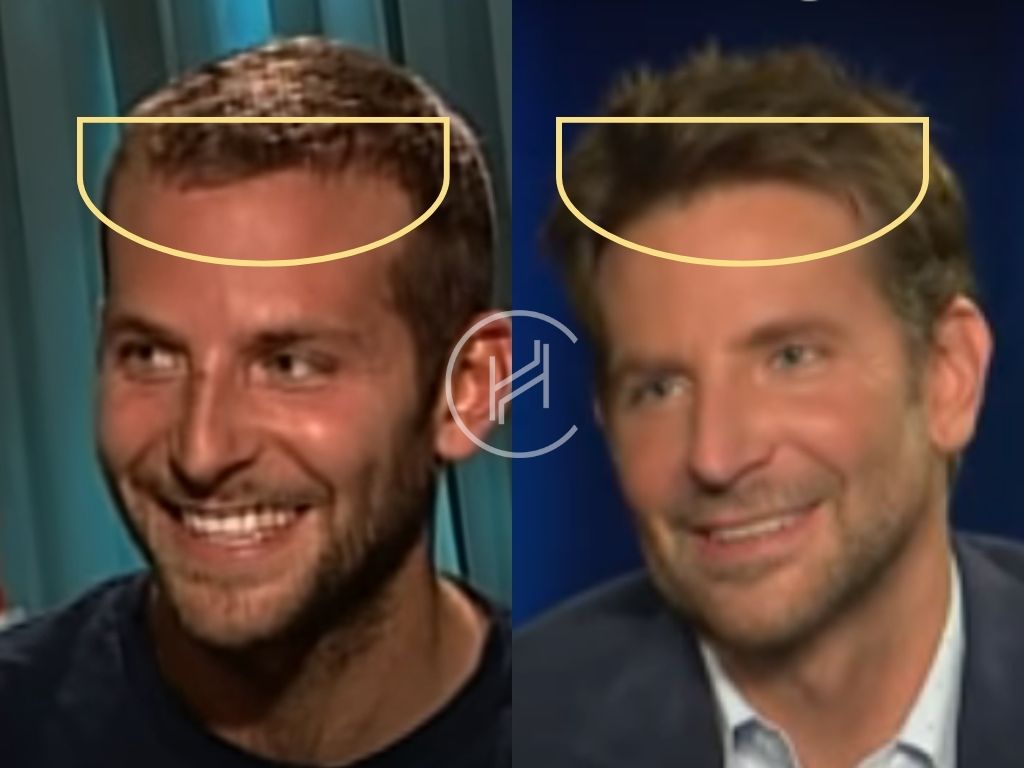 bradley cooper - hair transplant before and after result