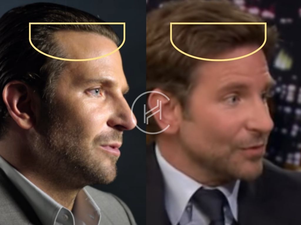 bradley cooper - hair transplant before and after