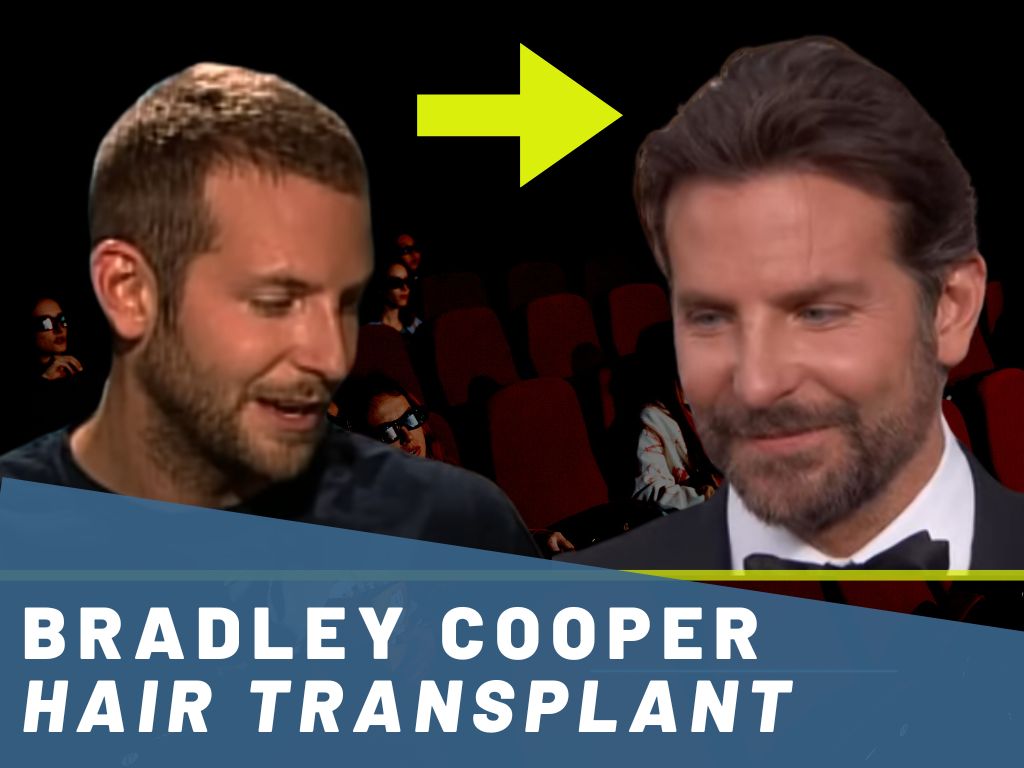 bradley-cooper-hair-transplant