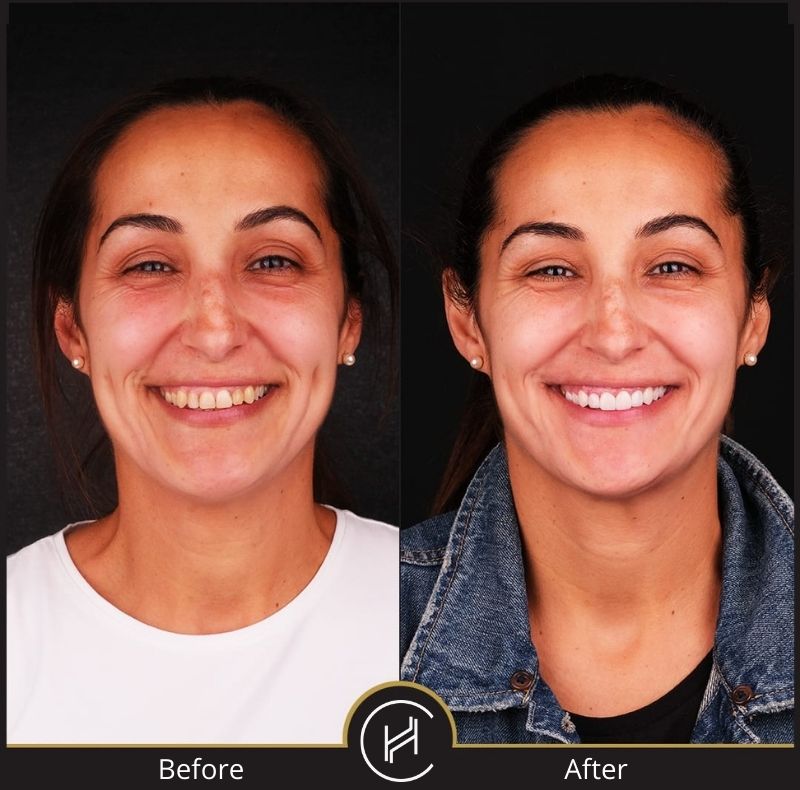 dental-veneers-before-after-female-patient dental veneers before after female patient